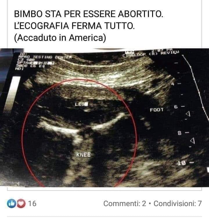 "Bimbo sta per essere abortito, l'ecografia ferma tutto": attenti alle pareidolie